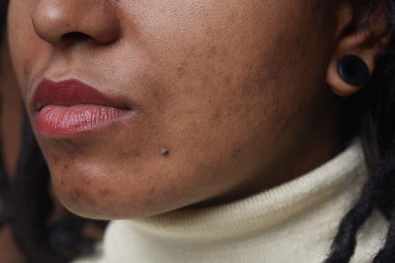 why teens get acne